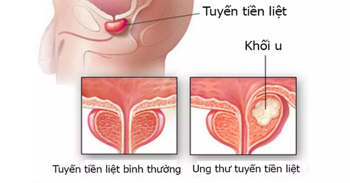 Ung thư tuyến tiền liệt giai đoạn đầu chữa khỏi được không?